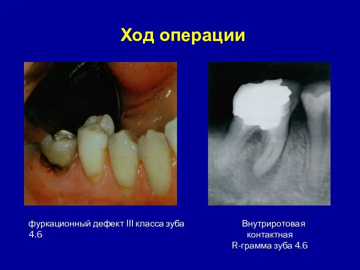фуркационный дефект III класса зуба 4.6 Внутриротовая контактная R-грамма зуба 4.6 Ход операции