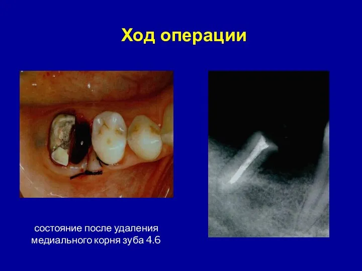 состояние после удаления медиального корня зуба 4.6 Ход операции