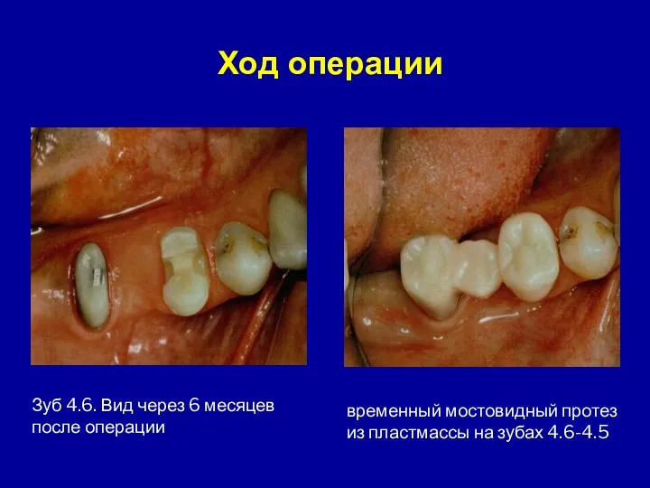 Зуб 4.6. Вид через 6 месяцев после операции временный мостовидный