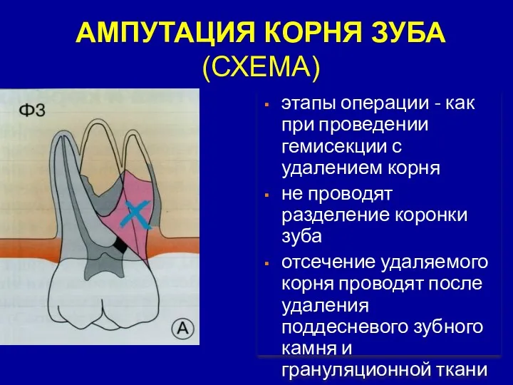 АМПУТАЦИЯ КОРНЯ ЗУБА (СХЕМА) этапы операции - как при проведении гемисекции с удалением