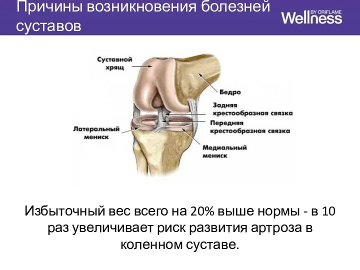 Причины возникновения болезней суставов Избыточный вес всего на 20% выше