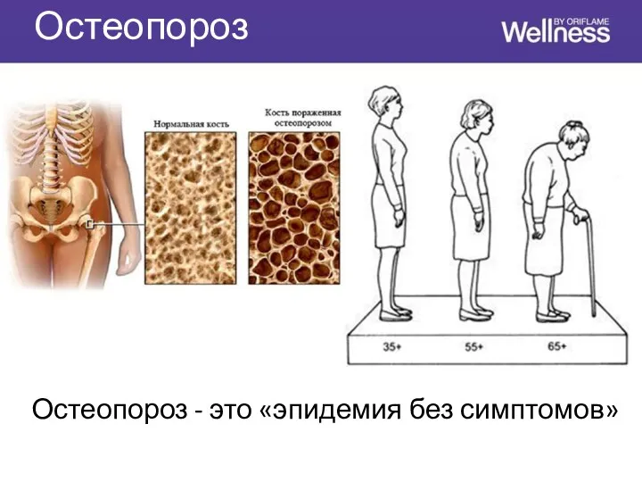 Остеопороз Остеопороз - это «эпидемия без симптомов»