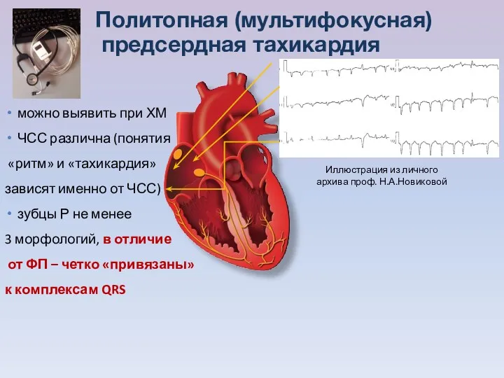 Политопная (мультифокусная) предсердная тахикардия можно выявить при ХМ ЧСС различна (понятия «ритм» и