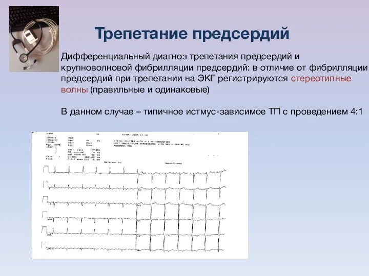 Дифференциальный диагноз трепетания предсердий и крупноволновой фибрилляции предсердий: в отличие от фибрилляции предсердий