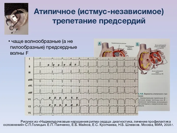 чаще волнообразные (а не пилообразные) предсердные волны F Атипичное (истмус-независимое) трепетание предсердий Рисунок