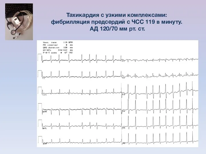 Тахикардия с узкими комплексами: фибрилляция предсердий с ЧСС 119 в минуту. АД 120/70 мм рт. ст.