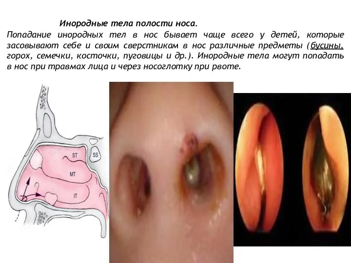 Инородные тела полости носа. Попадание инородных тел в нос бывает