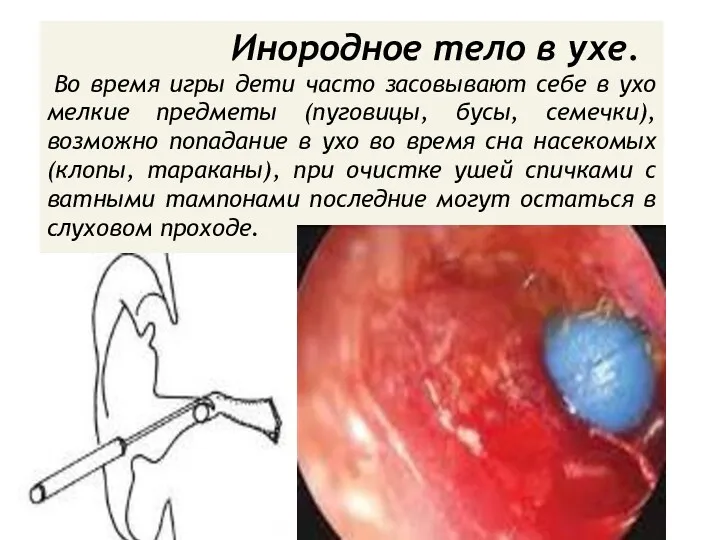 Инородное тело в ухе. Во время игры дети часто засовывают