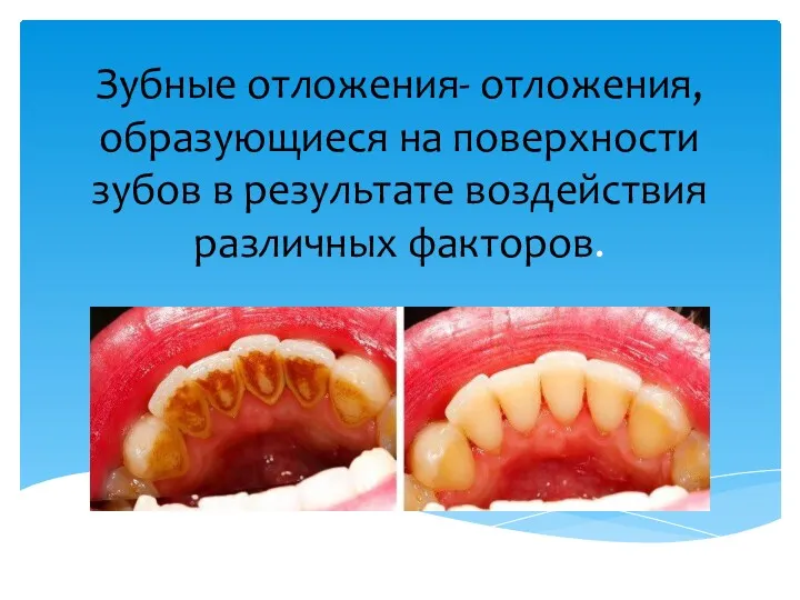 Зубные отложения- отложения, образующиеся на поверхности зубов в результате воздействия различных факторов.