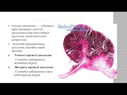 АСҚАЗАН АДЕНОМАСЫ: Асқазан аденомасы — тубулярлы құрылымдардан түзілген, дисплазиясы бар