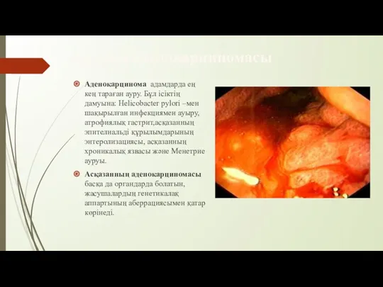 Асқазан аденокарциномасы Аденокарцинома адамдарда ең кең тараған ауру. Бұл ісіктің