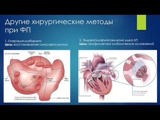 Другие хирургические методы при ФП 1. Операция «лабиринт» Цель: восстановление синусового ритма 2.