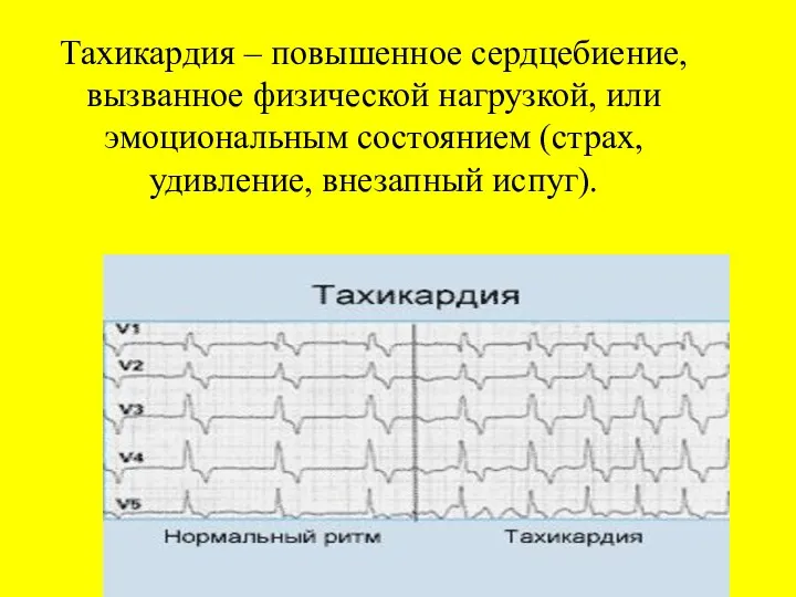 Тахикардия – повышенное сердцебиение, вызванное физической нагрузкой, или эмоциональным состоянием (страх, удивление, внезапный испуг).