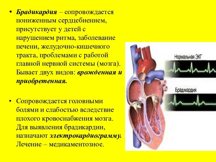 Брадикардия – сопровождается пониженным сердцебиением, присутствует у детей с нарушением