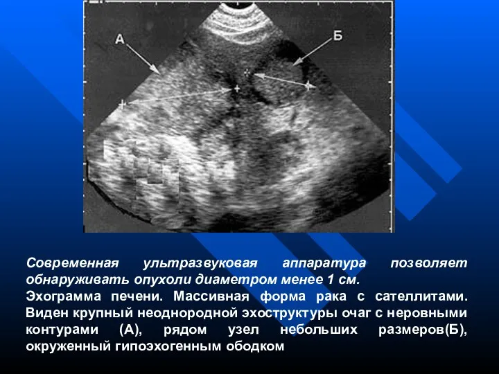 Современная ультразвуковая аппаратура позволяет обнаруживать опухоли диаметром менее 1 см.