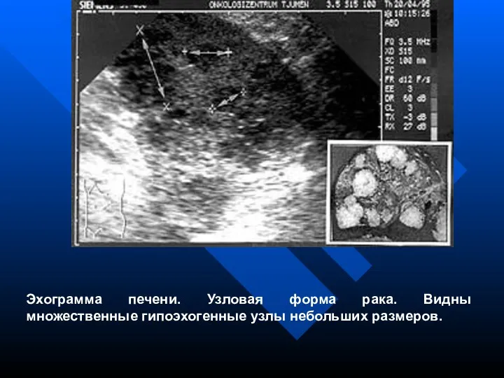 Эхограмма печени. Узловая форма рака. Видны множественные гипоэхогенные узлы небольших размеров.