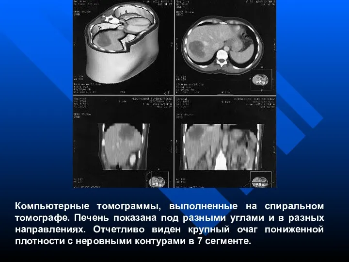 Компьютерные томограммы, выполненные на спиральном томографе. Печень показана под разными