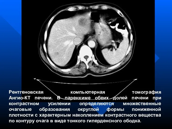 Рентгеновская компьютерная томография Ангио-КТ печени. В паренхиме обеих долей печени