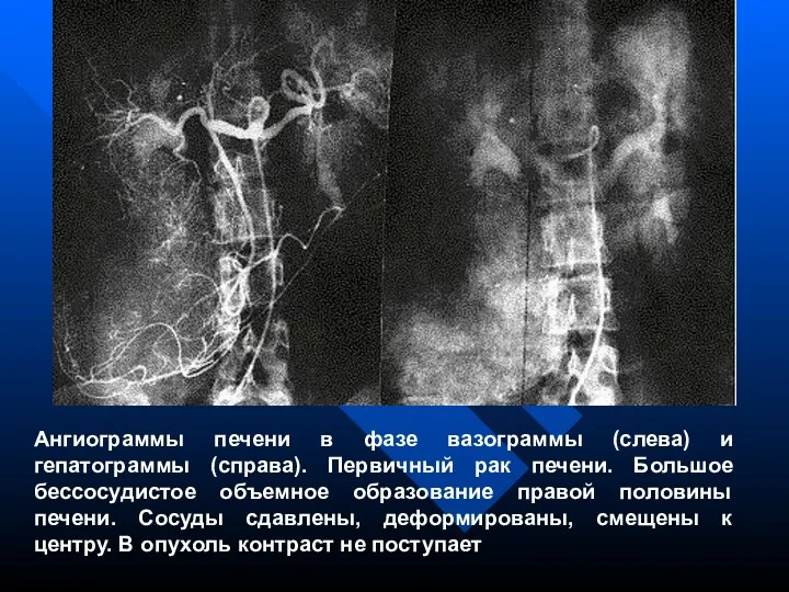 Ангиограммы печени в фазе вазограммы (слева) и гепатограммы (справа). Первичный