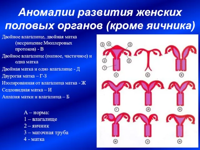 Аномалии развития женских половых органов (кроме яичника) Двойное влагалище, двойная