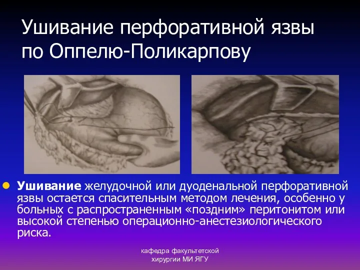 кафедра факультетской хирургии МИ ЯГУ Ушивание перфоративной язвы по Оппелю-Поликарпову