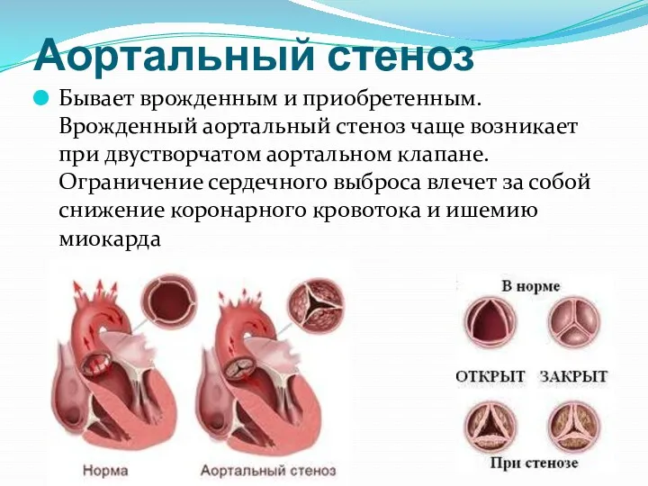 Аортальный стеноз Бывает врожденным и приобретенным. Врожденный аортальный стеноз чаще