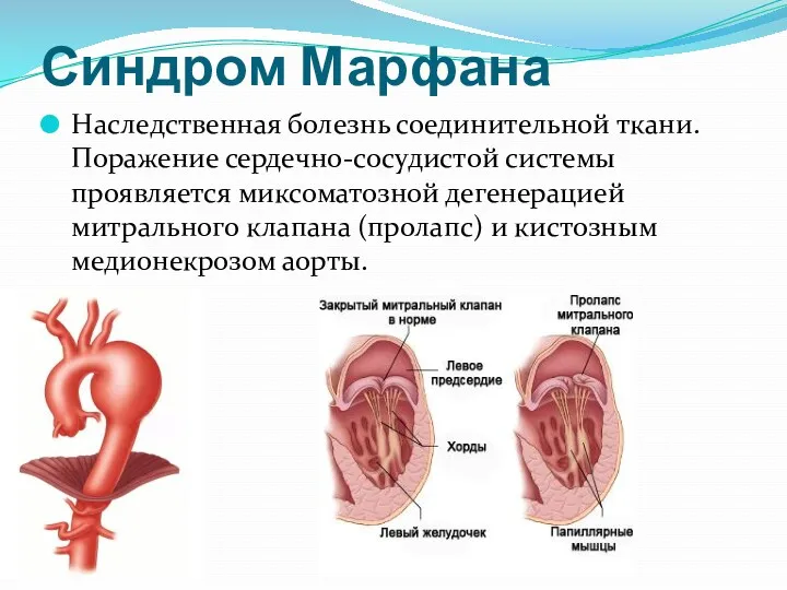 Синдром Марфана Наследственная болезнь соединительной ткани. Поражение сердечно-сосудистой системы проявляется