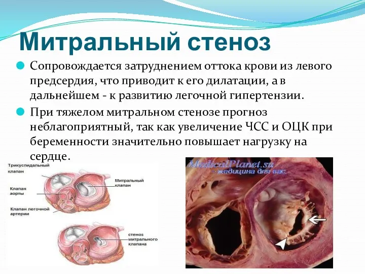 Митральный стеноз Сопровождается затруднением оттока крови из левого предсердия, что