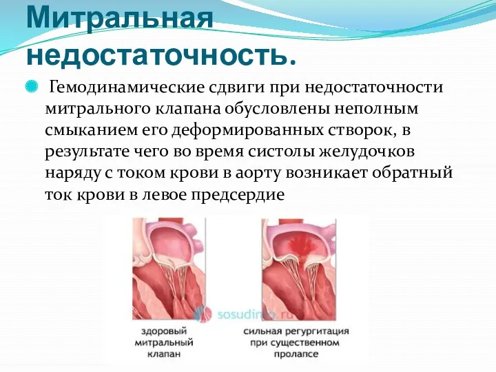 Митральная недостаточность. Гемодинамические сдвиги при недостаточности митрального клапана обусловлены неполным