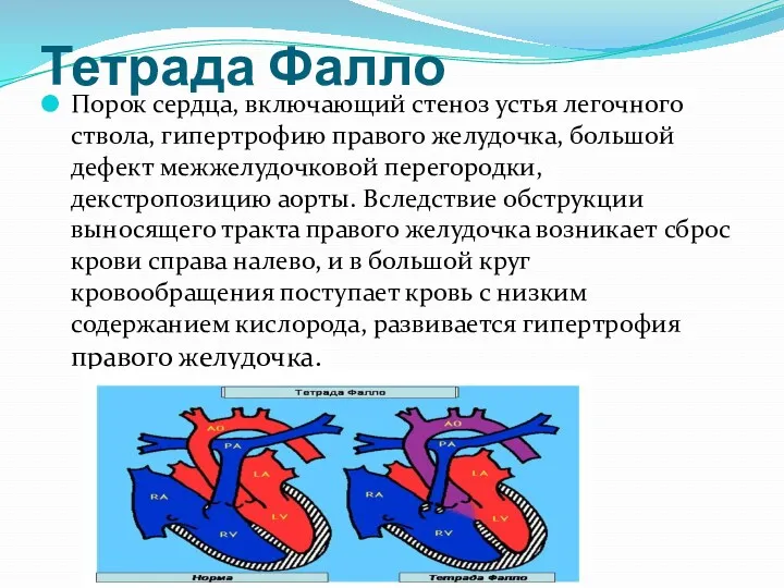 Тетрада Фалло Порок сердца, включающий стеноз устья легочного ствола, гипертрофию