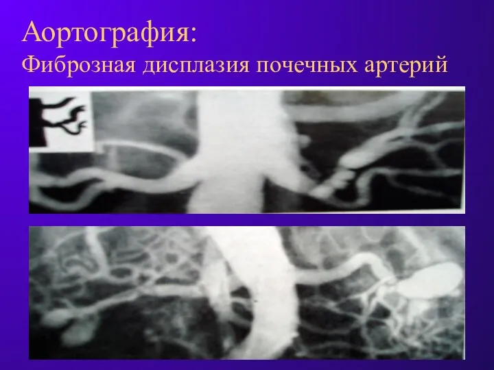 Аортография: Фиброзная дисплазия почечных артерий