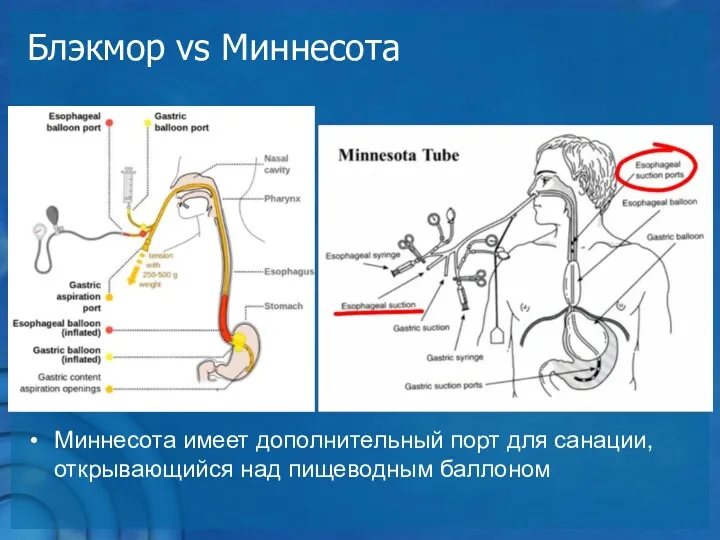 Блэкмор vs Миннесота Миннесота имеет дополнительный порт для санации, открывающийся над пищеводным баллоном