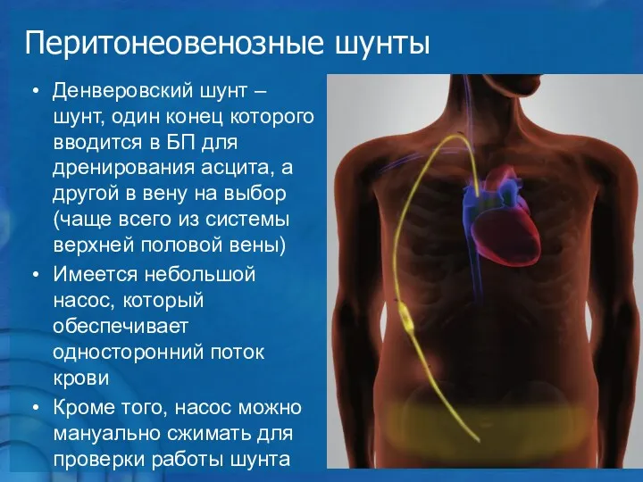 Перитонеовенозные шунты Денверовский шунт – шунт, один конец которого вводится