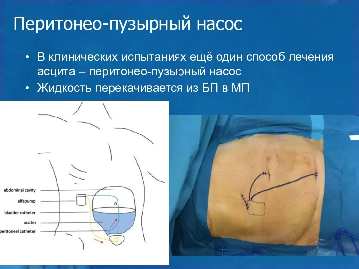 Перитонео-пузырный насос В клинических испытаниях ещё один способ лечения асцита