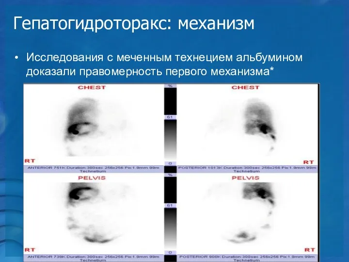 Гепатогидроторакс: механизм Исследования с меченным технецием альбумином доказали правомерность первого механизма*