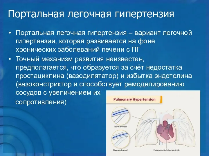 Портальная легочная гипертензия Портальная легочная гипертензия – вариант легочной гипертензии,