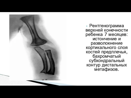 Рентгенограмма верхней конечности ребенка 7 месяцев: истончение и разволокнение кортикального