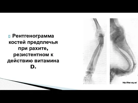 Рентгенограмма костей предплечья при рахите, резистентном к действию витамина D.