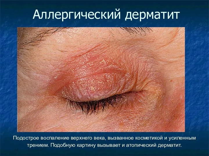 Аллергический дерматит Подострое воспаление верхнего века, вызванное косметикой и усиленным