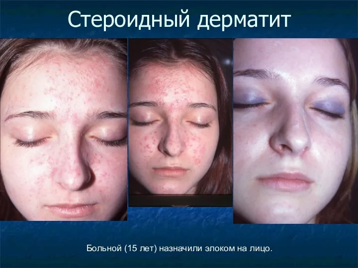Стероидный дерматит Больной (15 лет) назначили элоком на лицо.