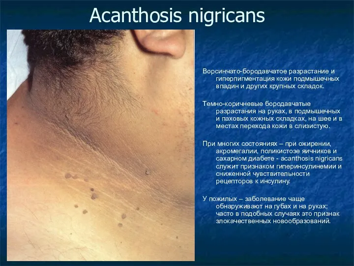 Acanthosis nigricans Ворсинчато-бородавчатое разрастание и гиперпигментация кожи подмышечных впадин и