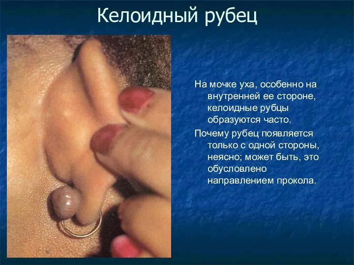 Келоидный рубец На мочке уха, особенно на внутренней ее стороне,
