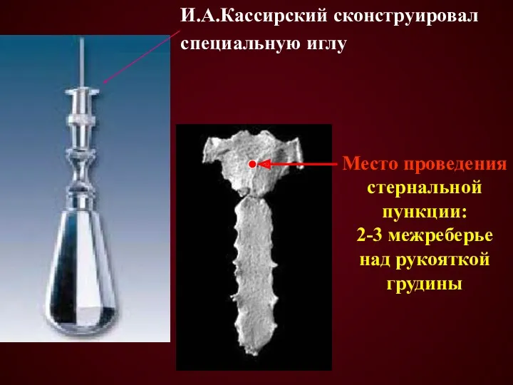 Место проведения стернальной пункции: 2-3 межреберье над рукояткой грудины И.А.Кассирский сконструировал специальную иглу