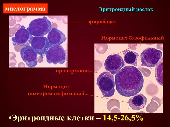 Эритроидный росток эриробласт пронормоцит Нормоцит базофильный Нормоцит полихроматофильный Эритроидные клетки – 14,5-26,5% миелограмма