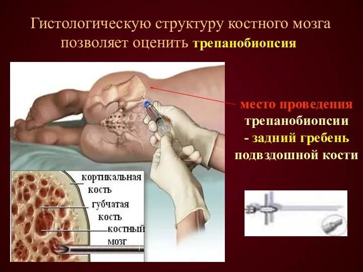 Гистологическую структуру костного мозга позволяет оценить трепанобиопсия место проведения трепанобиопсии - задний гребень подвздошной кости