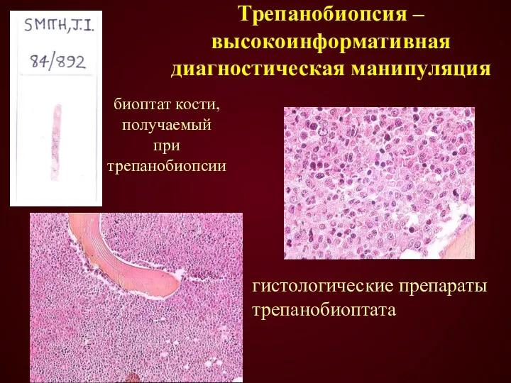 Трепанобиопсия –высокоинформативная диагностическая манипуляция биоптат кости, получаемый при трепанобиопсии гистологические препараты трепанобиоптата