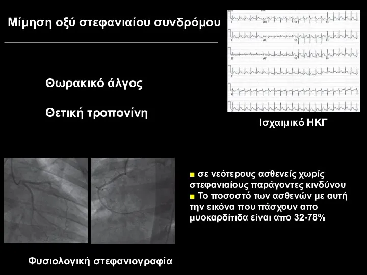 Μίμηση οξύ στεφανιαίου συνδρόμου Φυσιολογική στεφανιογραφία Θωρακικό άλγος Θετική τροπονίνη