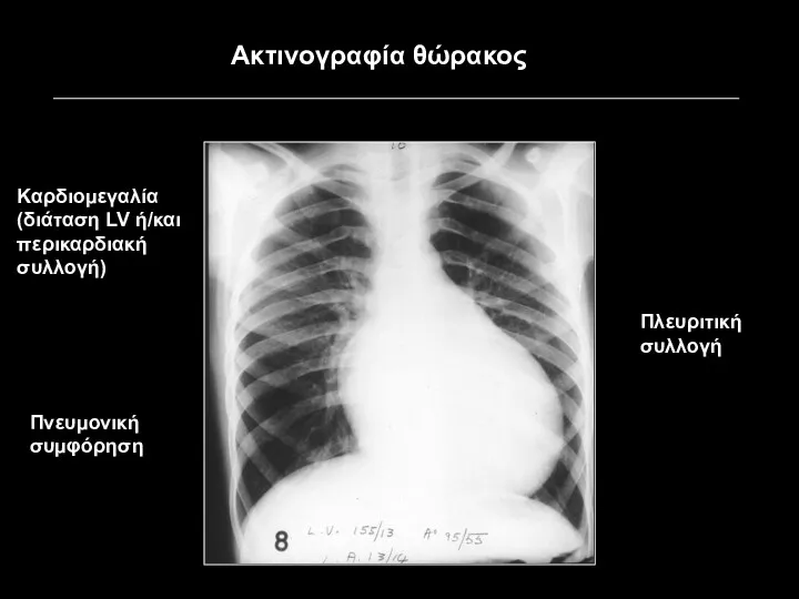 Καρδιομεγαλία (διάταση LV ή/και περικαρδιακή συλλογή) Πνευμονική συμφόρηση Πλευριτική συλλογή Ακτινογραφία θώρακος