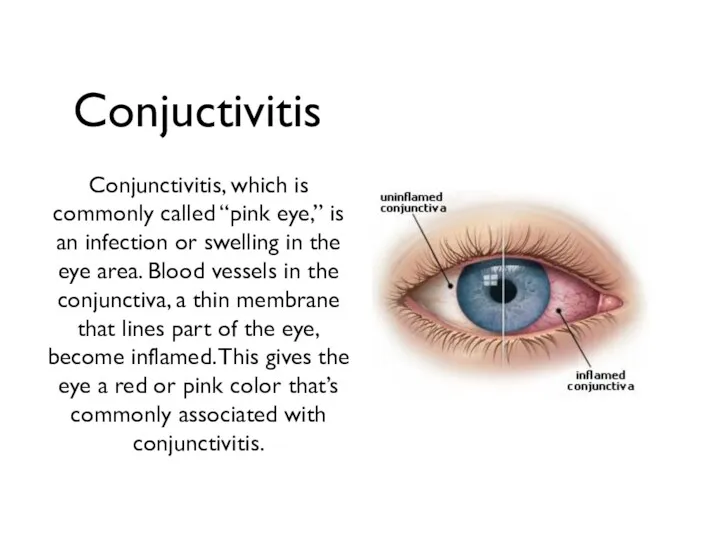 Conjuctivitis Conjunctivitis, which is commonly called “pink eye,” is an infection or swelling