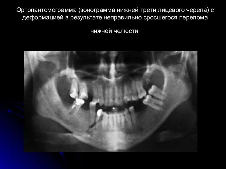 Ортопантомограмма (зонограмма нижней трети лицевого черепа) с деформацией в результате неправильно сросшегося перелома нижней челюсти.